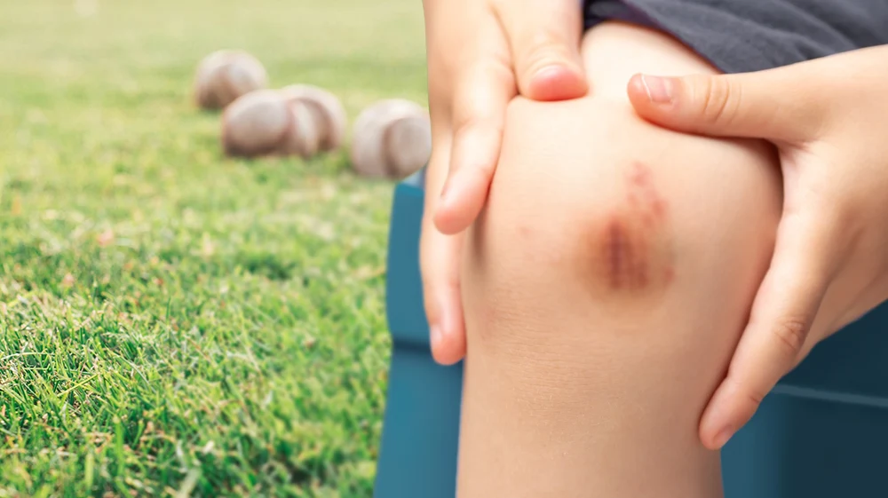 Bruises