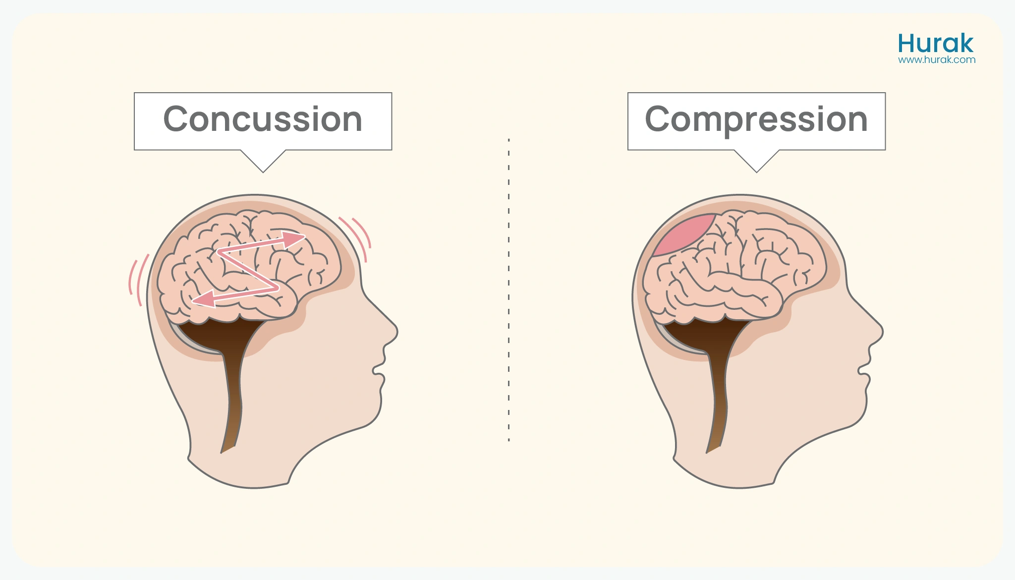 Concussion VS Compression