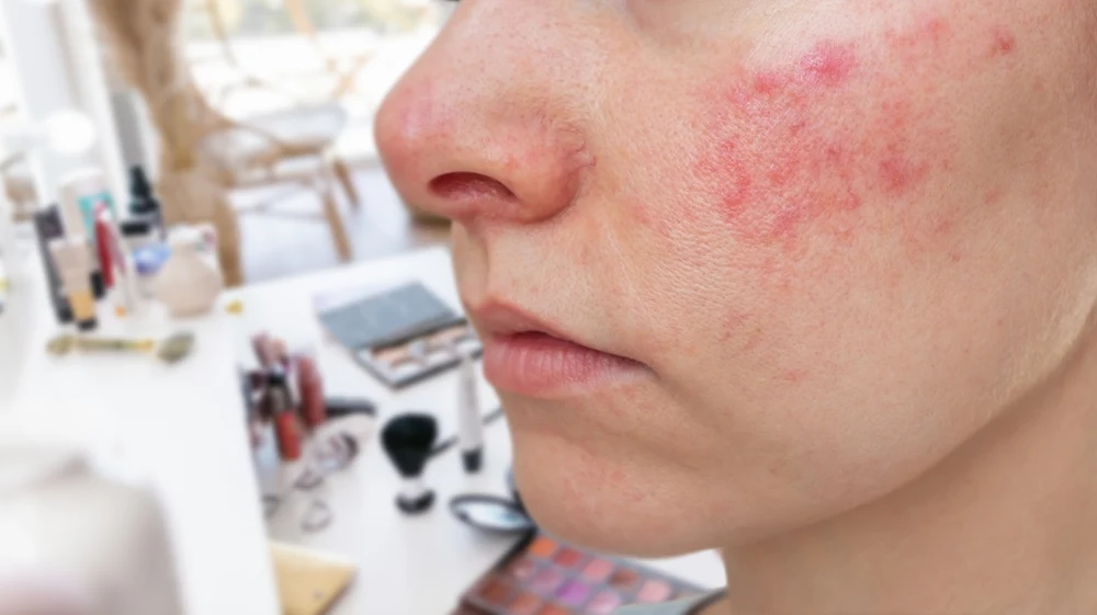 Slapped Cheek Syndrome