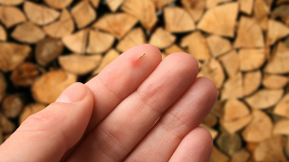 safe removal of a splinter
