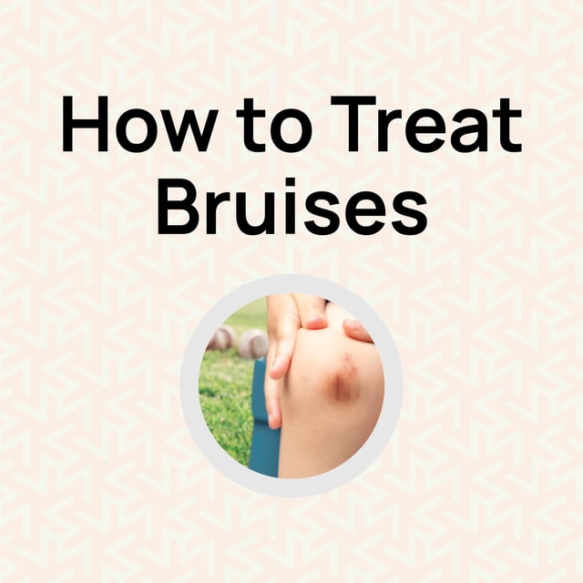 How to Treat Bruises