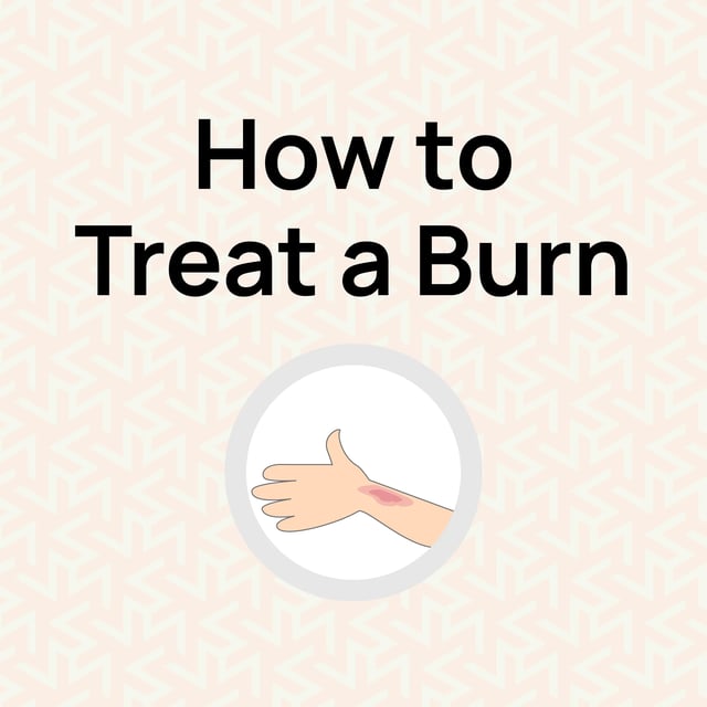 How to Treat a Burn