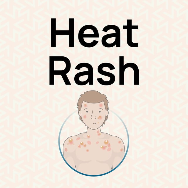 complete-guide-to-heat-rash-relief-uk-guide-hurak