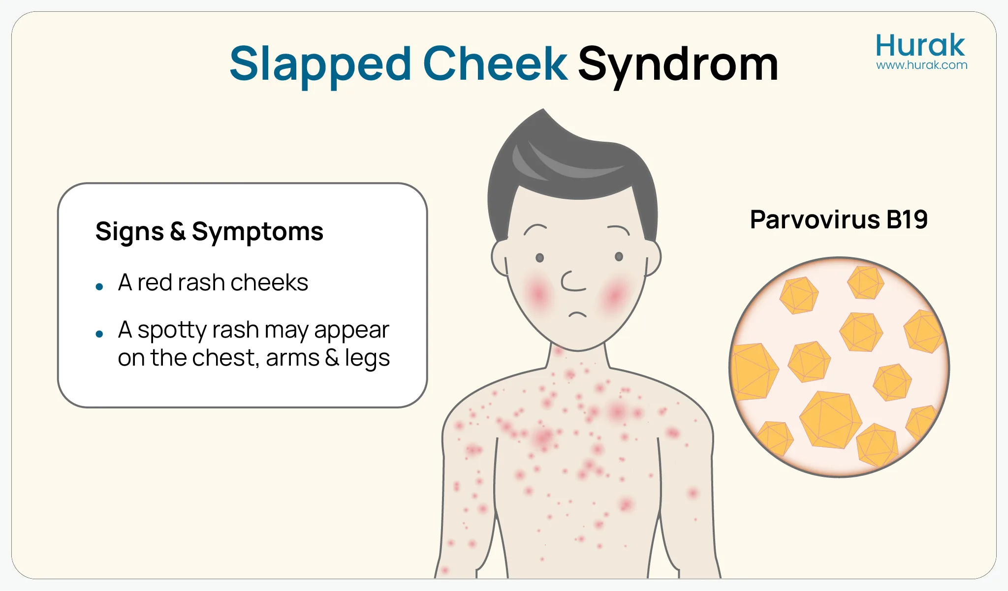 What slapped cheek looks like on a child, featuring a rash on cheeks