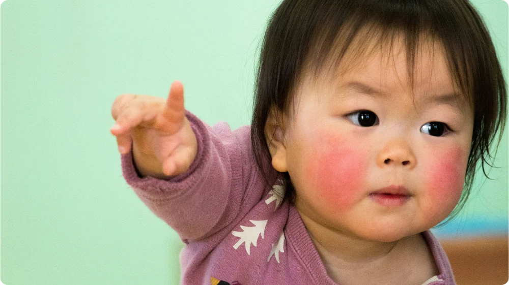 Child with scarlet fever symptoms