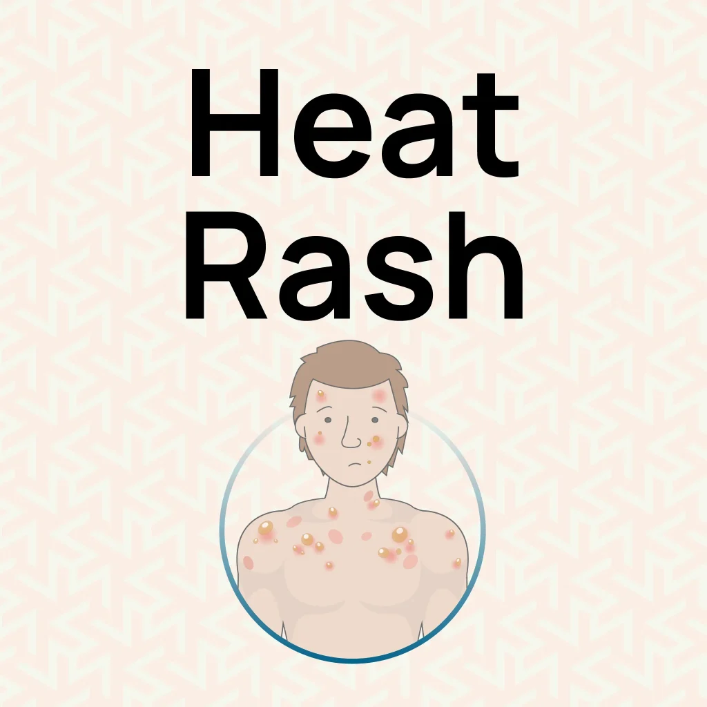 Heat Rash reief Infographic